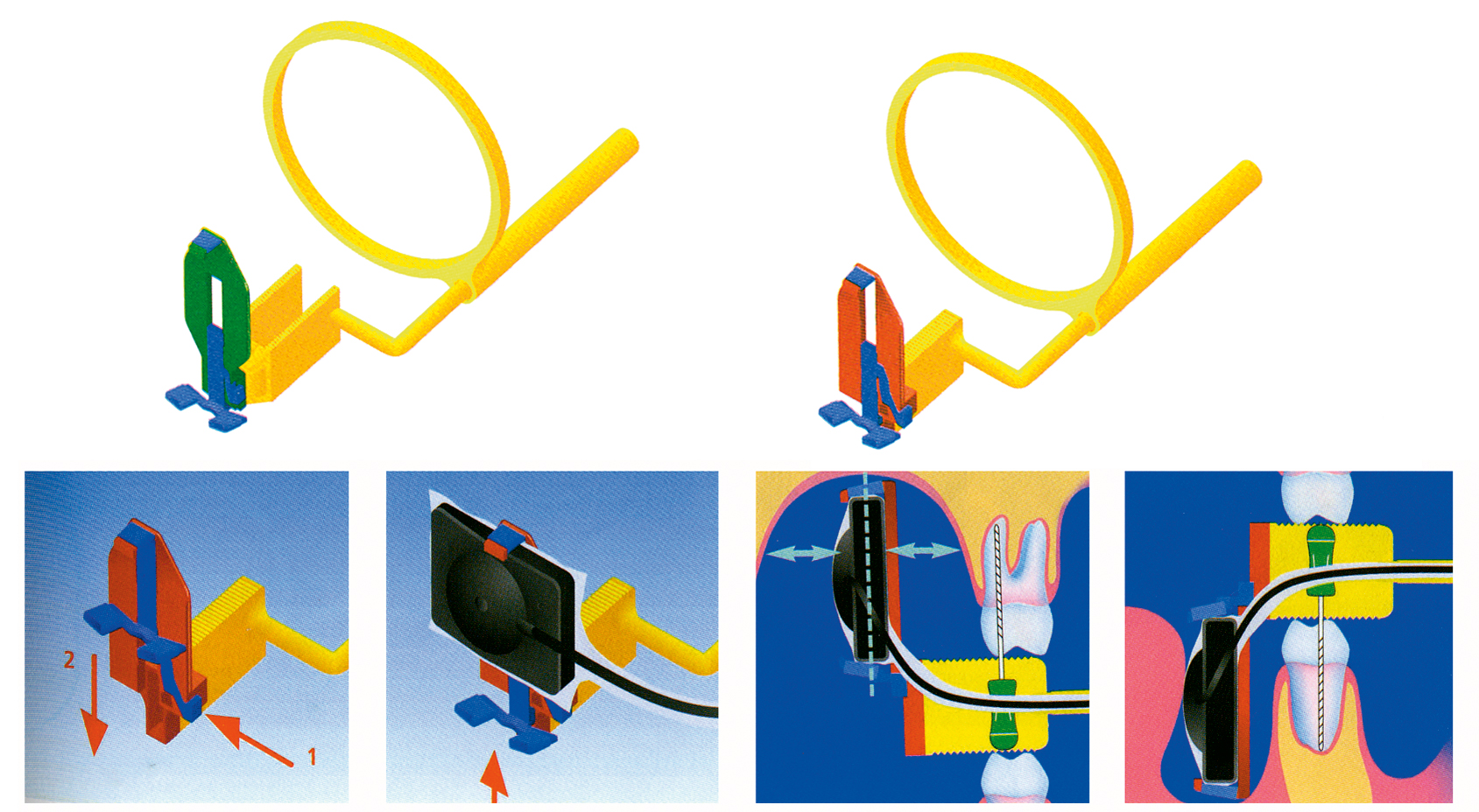 Endo-Bite Senso Kit 2900