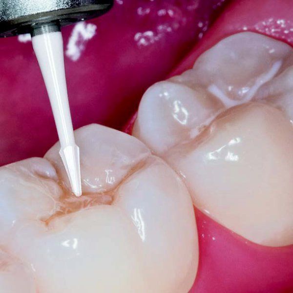 Ceramic fissurborr , Fg, 5st